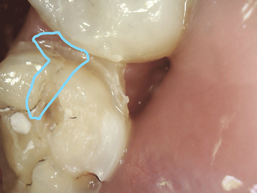 Cracked molar
